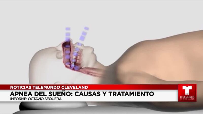 Apnea del Sueño: Conozca sus causas y tratamiento